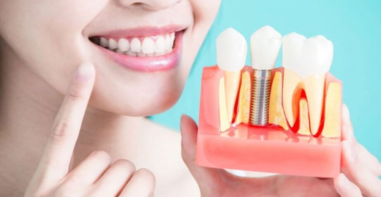 Benefits of a Dental Implant